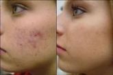 Kit de Tratamento para Acne