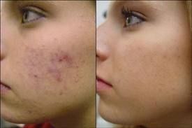 Kit de Tratamento para Acne
